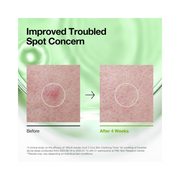 ANUA Azelaic Acid 3 CICA Clarifying Toner – Soothing & Exfoliating Toner with Salicylic Acid, AHA, and BHA for Sensitive, Acne-Prone Skin